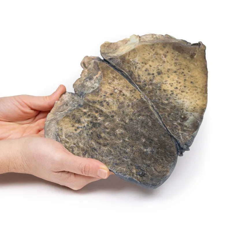 3D Printed Bronchopneumonia